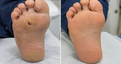 Diabetic Foot